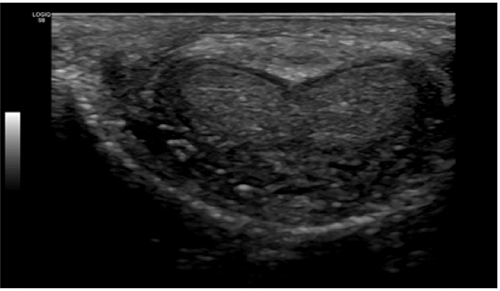 Mondor s disease of the penis due to asymptomatic infective